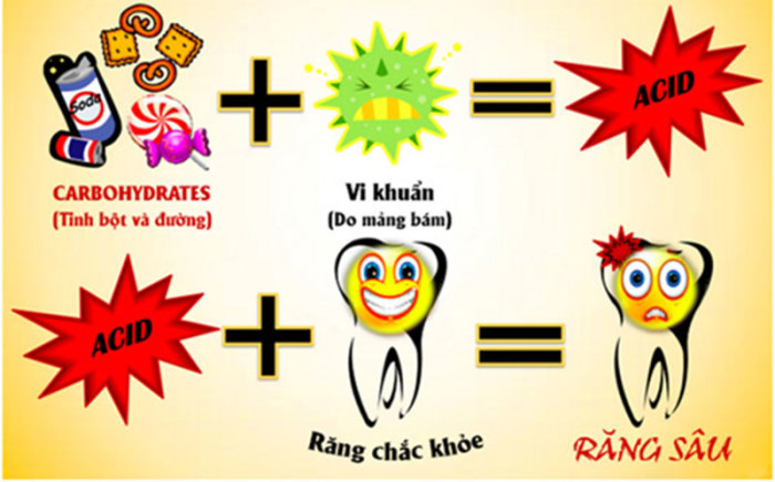 Sâu răng là gì, nguyên nhân, triệu chứng, cách điều trị