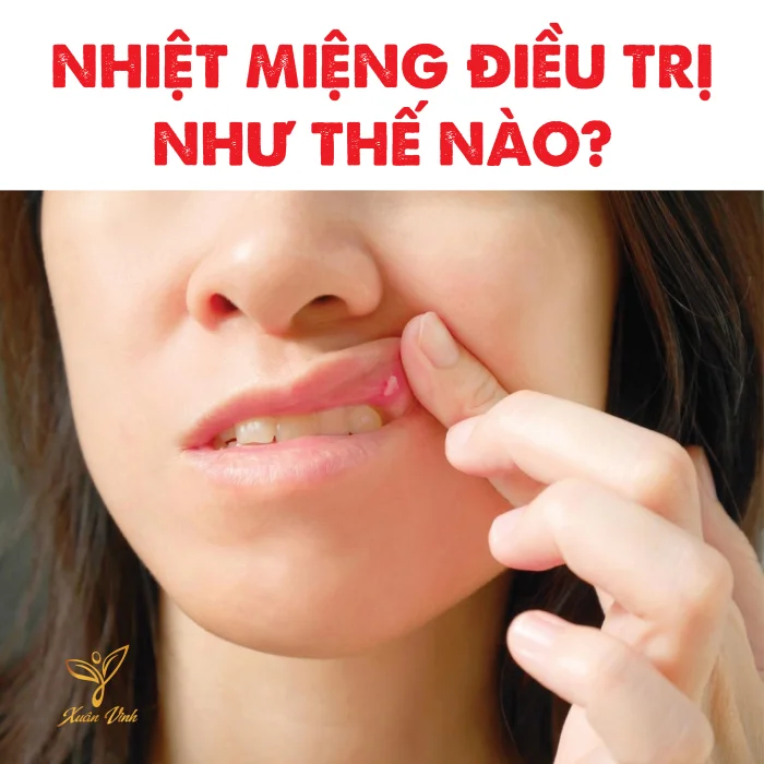 BỆNH NHIỆT MIỆNG VÀ CÁCH ĐIỀU TRỊ BỆNH HIỆU QUẢ