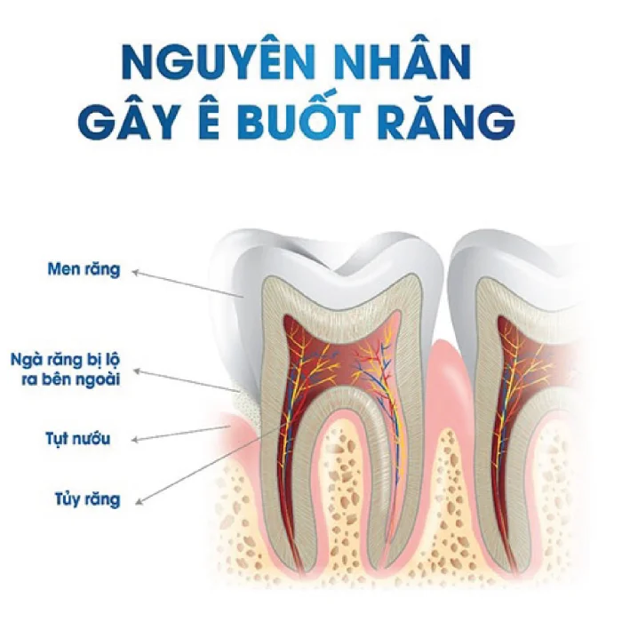 NGUYÊN NHÂN VÀ CÁCH CHỮA TRỊ - RĂNG Ê BUỐT