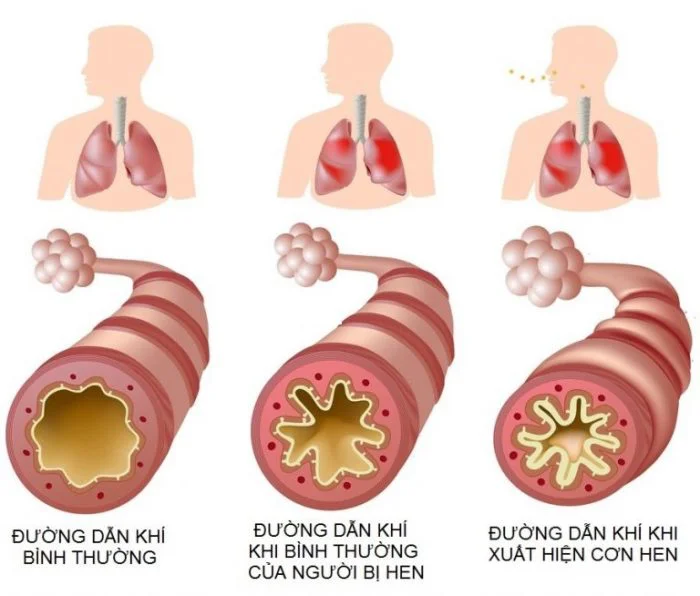 THUỐC LÁ VÀ BỆNH LÝ ĐƯỜNG HÔ HẤP